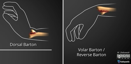 Types of Barton Wrist Fracture. Dorsal Barton Fracture (lump on back of wrist) and Volar Barton (lump on front of wrist).Copyright Radiopaedia