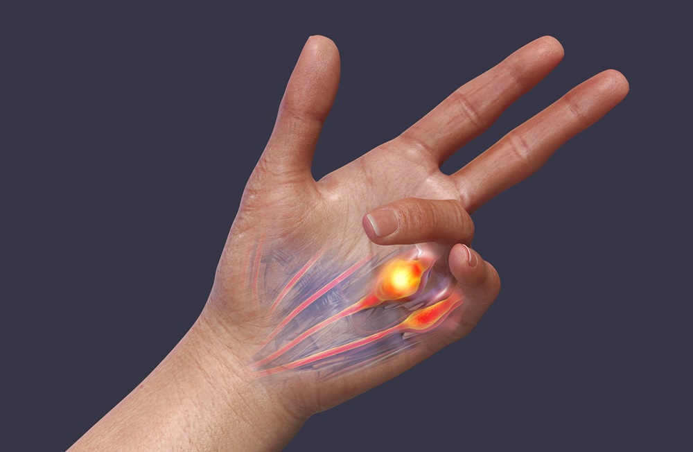 Dupuytren's Contracture: nodules form in the fascia