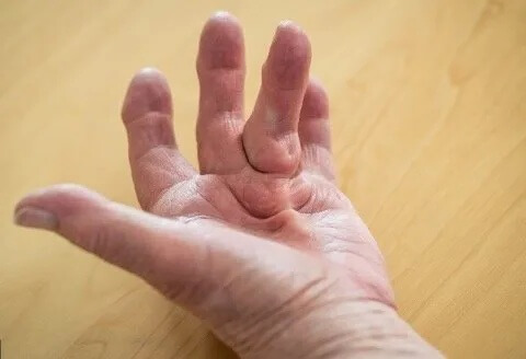 Dupuytren Contracture: Causes, symptoms, diagnosis and treatment