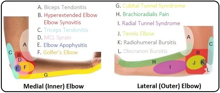 Elbow Pain Diagnosis Chart: use our elbow pain diagram to work out what is causing your pain Elbow Pain Diagnosis Chart: use our elbow pain diagram to work out what is causing your pain