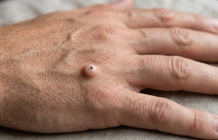 Epidermoid Cyst On Back Of Hand: A small lump on back of hand with a dark central pore is usually an epidermoid cyst. Find out about causes, symptoms and treatment