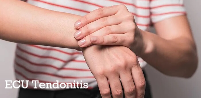 Extensor Carpi Ulnaris Tendonitis: Causes, symptoms, diagnosis and treatment for ECU Tendonitis