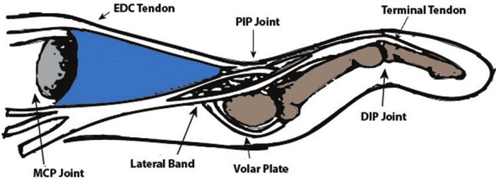 Extensor mechanism of the fingers: disruption leads to finger deformity