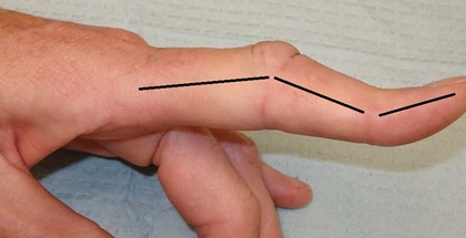 Finger Joint Pain: Boutonniere Deformity. Find out about the common causes, symptoms and best treatment options