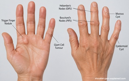 Finger Lump In Hand: Common causes of fingers lumps, symptoms, diagnosis and best treatment options