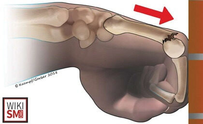 Causes of Finger Pain: Finger Fractures are common after punching a hard surface and cause pain and swelling. Find out about the causes, symptoms and treatment options