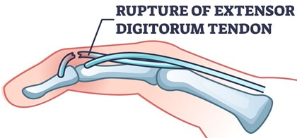 Finger Pain Causes: Mallet Finger results in a classic drooping at the fingertip due to tendon damage. Find out about the causes, symptoms and treatment options