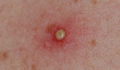 Folliculitis Cysts On Shoulder Folliculitis Cysts On Shoulder