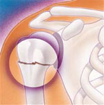 Upper arm pain may indicate a fractured humerus (aka broken arm)