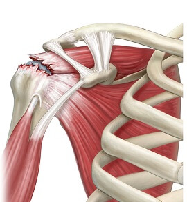 Pain clearance lifting arm