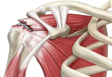 https://www.shoulder-pain-explained.com/images/front-shoulder-pain-torn-rotator-cuff.jpg