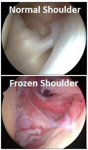 A frozen shoulder causes pain and stiffness in the shoulder and arm