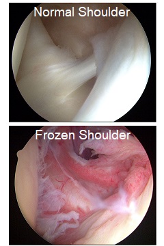 Images from arthroscopies comparing a normal shoulder to one with adhesive capsulitis aka Frozen Shoulder