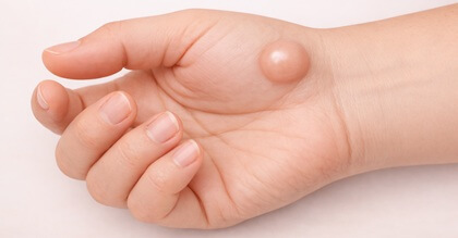 Ganglion Cyst Lump On Palm Of Hand: Ganglion cysts are a common cause of palm lumps. Find out about the causes, symptoms and treatment options