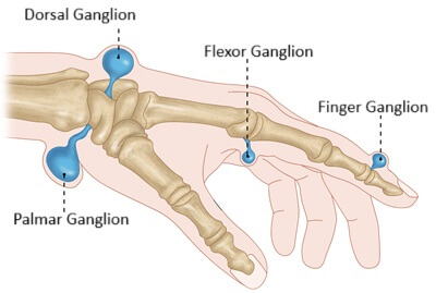 Ganglion Cyst Wrist Locations: Ganglions can occur anywhere around the wrist and hand but are most common on the back of the hand (dorsal ganglion)