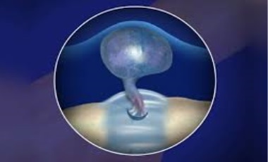 Ganglion Cyst Shoulder: Causes, symptoms, diagnosis and treatment Ganglion Cyst Shoulder: Causes, symptoms, diagnosis and treatment