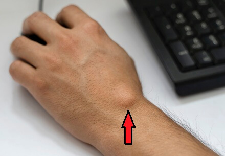 Ganglion Cyst Wrist: Symptoms, causes and treatment for these common wrist lumps