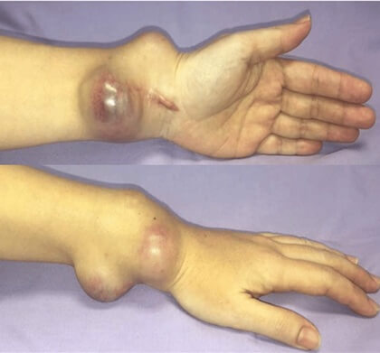 Giant cell tumors can cause large lumps on the wrist