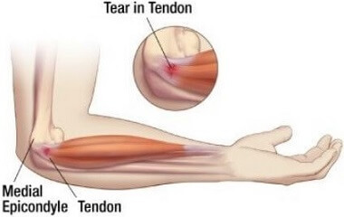 Golfers Elbow aka Medial Epicondylitis Golfers Elbow aka Medial Epicondylitis