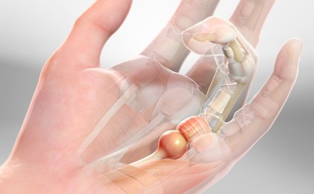 Hand and Finger Pain: Trigger Finger is one of the most common causes of finger pain. Find out about causes, symptoms and treatment options