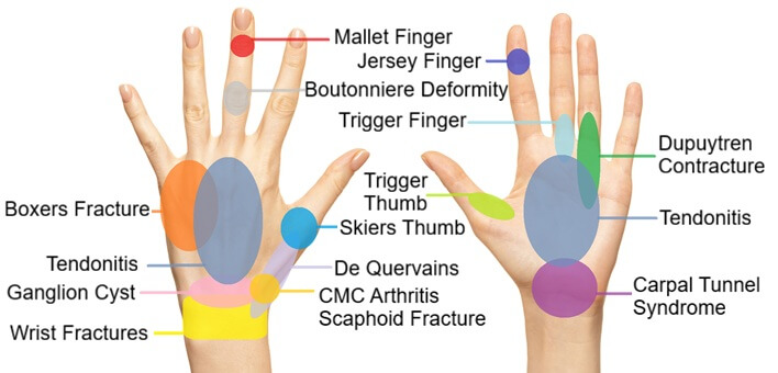 Hand Pain Diagram Location Chart: Our diagram of hand pain helps you work out what is causing your pain and the best ways to treat it
