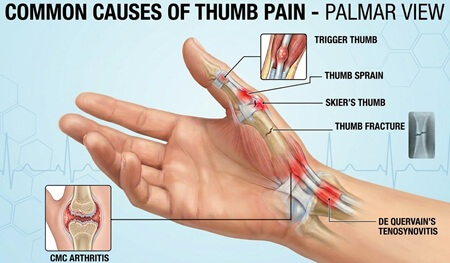 Hand Thumb Pain Diagram: Common causes of thumb pain and how to treat them.