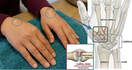 Hard Lump On Back Of Hand: Carpal Boss. Excess bone growth in the carpometacarpal joints causes and hard bony lump to form. Find out about the causes, symptoms and treatment options for Carpal Boss