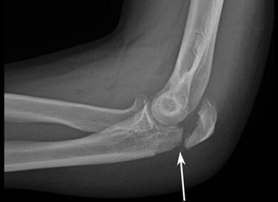 A hard lump on the elbow may be a sign of a fracture or dislocation following an injury