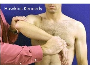 Hawkins Kennedy test for supraspinatus tendonitis of the shoulder Hawkins Kennedy test for supraspinatus tendonitis of the shoulder