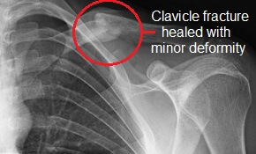 This clavicle fracture has healed but the patient has been left with some deformity