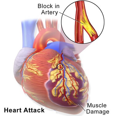 Left upper arm pain can be caused by heart problems - this is a medical emergency