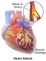 Left upper arm pain can be caused by heart problems - this is a medical emergency