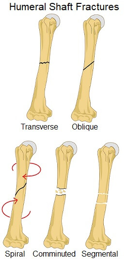 Humerus Fracture Types
