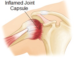 The effect on the joint capsule with a frozen shoulder (aka adhesive capsulitis)