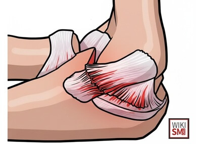 Medial Elbow Pain: MCL Sprain aka ulnar collateral ligament injury