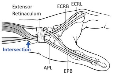 Intersection Syndrome Anatomy: The tendons of APL & EPB cross over ECRB & ECRL