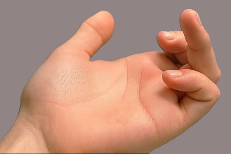 Jersey Finger: Flexor Tendon Injury. Causes, symptoms, diagnosis and treatment of sweater finger/rugby finger Jersey Finger: Flexor Tendon Injury. Causes, symptoms, diagnosis and treatment of sweater finger/rugby finger