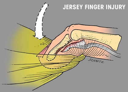Illustration of typical jersey finger mechanism of injury. WikiSM