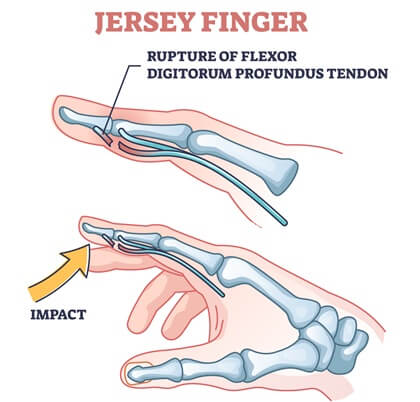Jersey Finger: Flexor tendon injury of flexor digitorum profundus limits active fingertip flexion Jersey Finger: Flexor tendon injury of flexor digitorum profundus limits active fingertip flexion