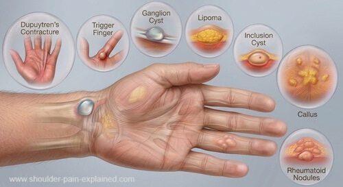 lump in palm 500 gem opt apr 26