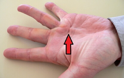 Lump In Palm Pain: Dupuytren's Contracture is a common cause of a lump in the palm. Find out about the causes, symptoms and treatment for Dupuytren's pain in palm of hand