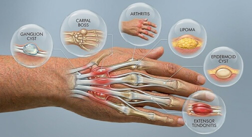 Lump On Back Of Hand: Common causes of lumps on the back of the hand and how to treat them