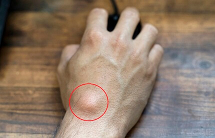 Lump On Back Of Hand: A ganglion cyst is a common cause of a soft or firm lump on the back of the hand. Find out about the causes, symptoms, diagnosis and treatment of a ganglion cyst on back of hand.