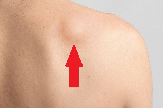 Lump On Shoulder: Causes, Diagnosis & Treatment - Shoulder Pain Exp