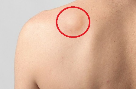 Lump On Back Of Shoulder: Causes, symptoms, diagnosis and treatment of the different causes of lumps and bumps behind the shoulder Lump On Back Of Shoulder: Causes, symptoms, diagnosis and treatment of the different causes of lumps and bumps behind the shoulder
