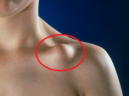 Lump On Collarbone: Causes, Symptoms, Diagnosis & Treatment for Clavicle Lumps