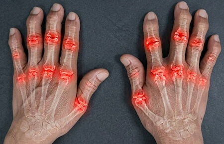 Arthritis Lump Back Of Hand: Arthritis is a common cause of a lump on knuckle of hand. Find out about the causes, symptoms, diagnosis and treatment.