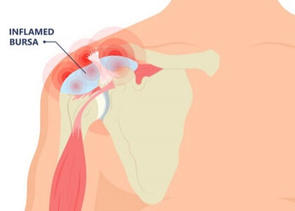 Shoulder Bursitis Lump On Top Of Shoulder: Causes, Symptoms, Diagnosis & Treatment