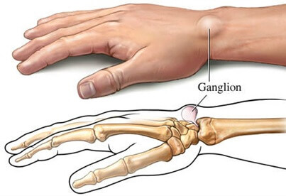 Ganglion Cyst Lump On Wrist: The most common cause of wrist bumps are ganglion cysts