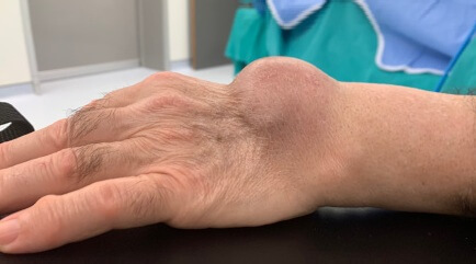 Lump On Wrist: Causes, symptoms and treatment options for bump on wrist